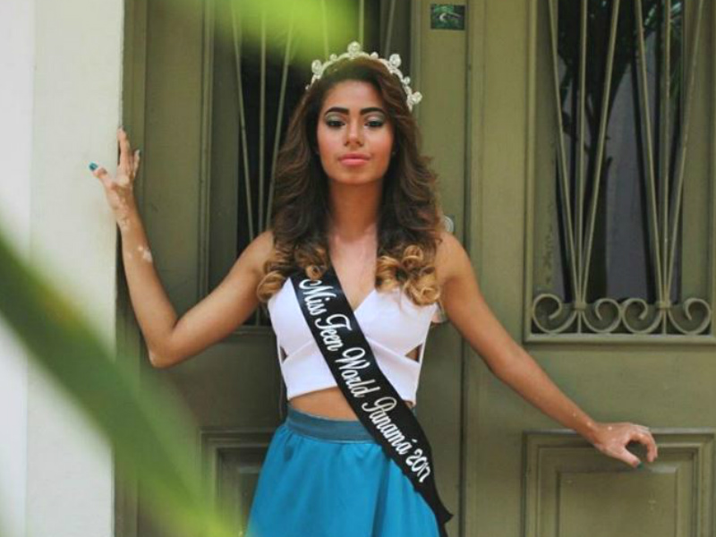 ¡Discriminación! Por tener vitiligo se le negó la participación a Miss Turismo Panamá Internacional